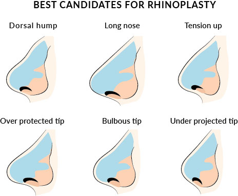 Rhinoplasty