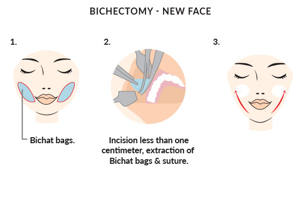 Bichectomy new face