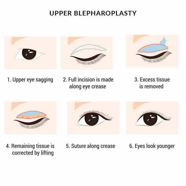 upper Blepharoplasty