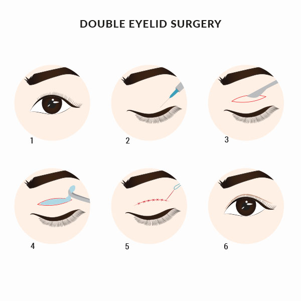 Blepharoplasty double eyelid