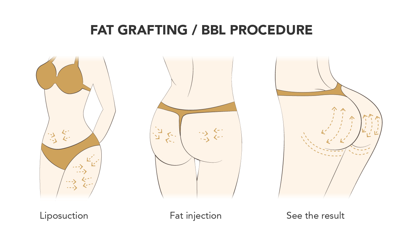 What is a BBL (Brazilian Butt Lift)? Benefits, Costs, & More