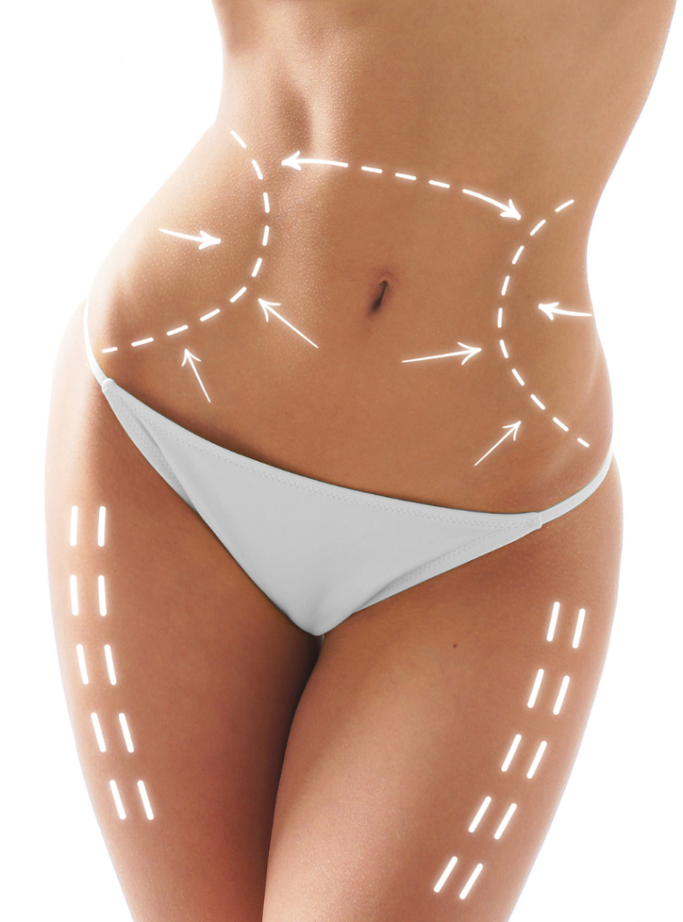 Tummy Tuck Surgery