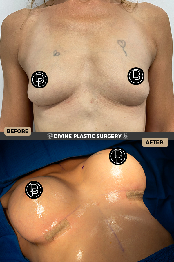 Breast Augmentation