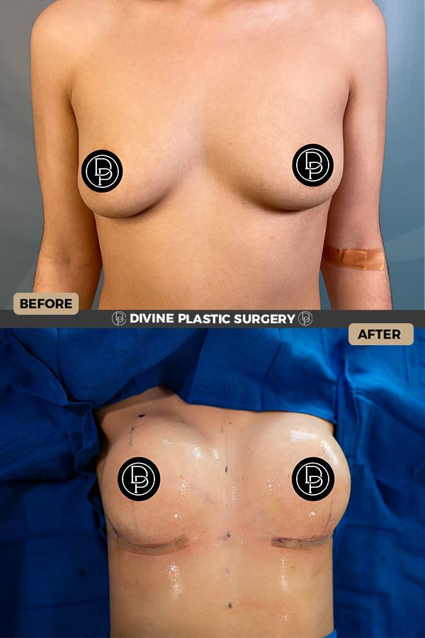 Breast Augmentation