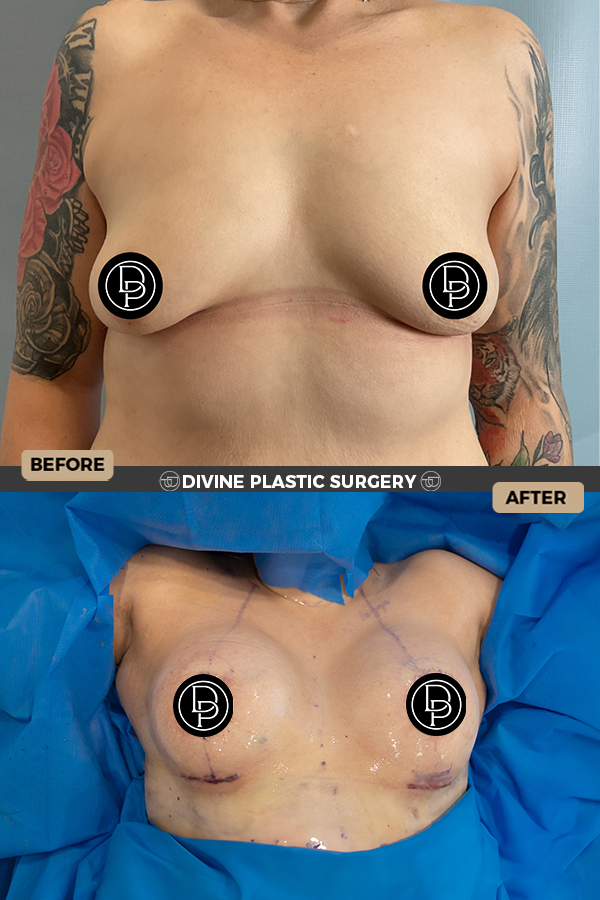 Breast Aug