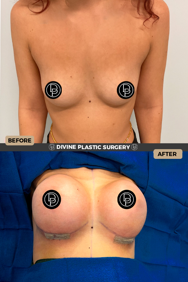 Breast Augmentation