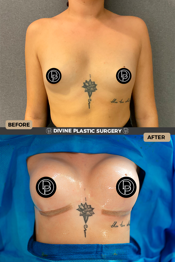 Breast Augmentation