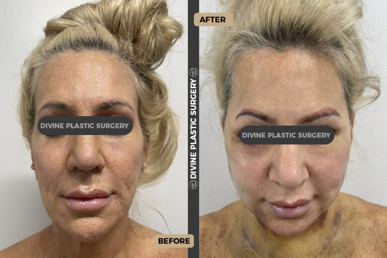 Facelift surgery