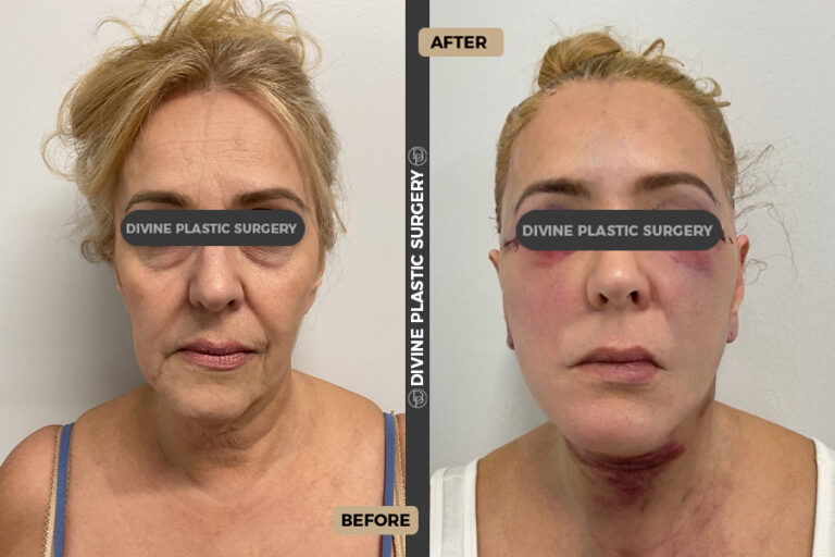 Facelift surgery