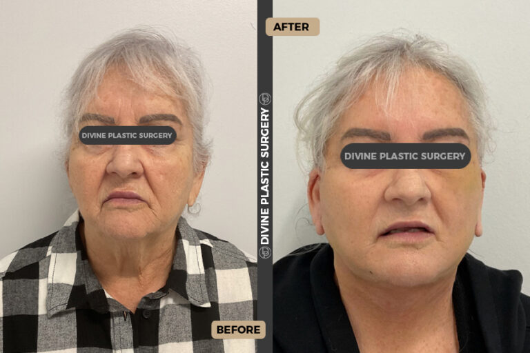 Facelift surgery