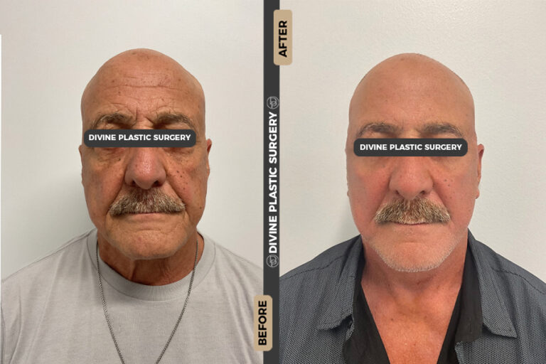 Facelift