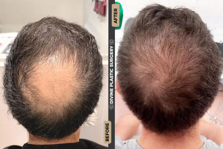 hair implant