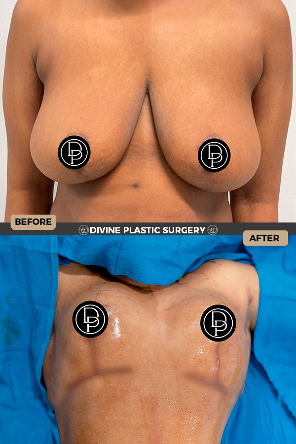Breast Lift Surgery