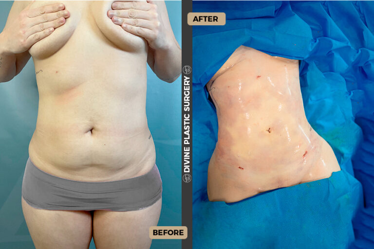 Abdominal fat removal
