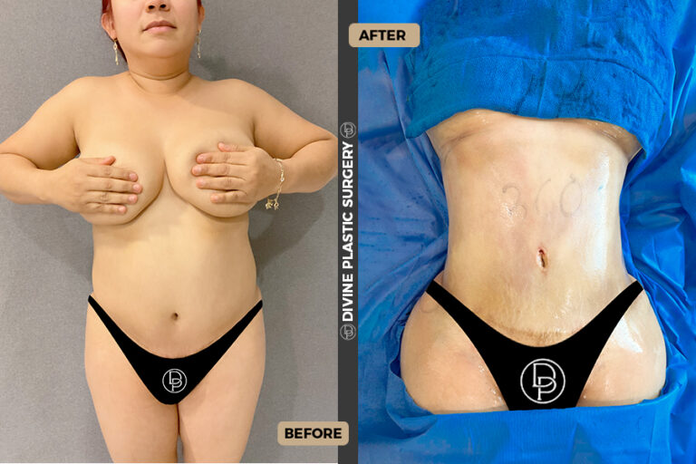 Abdominal fat removal