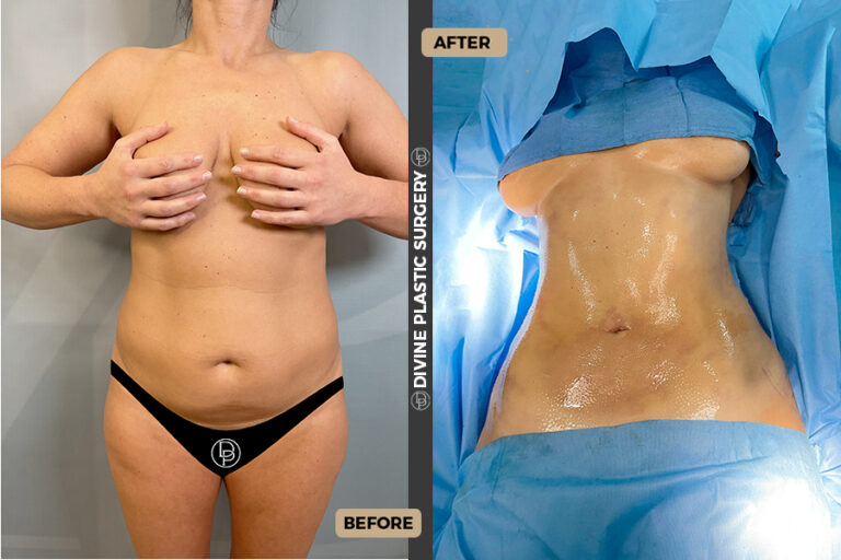 Abdominal fat removal