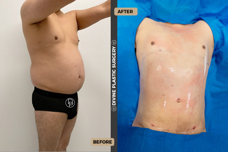 Abdominal reduction