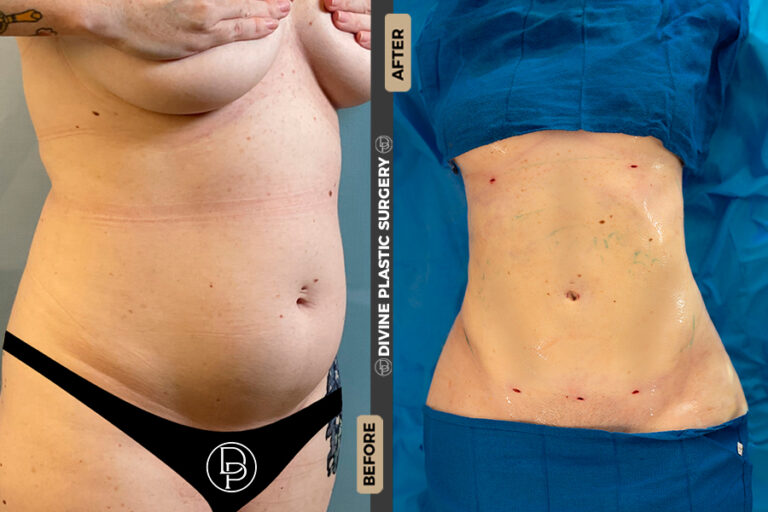 Lipo 360