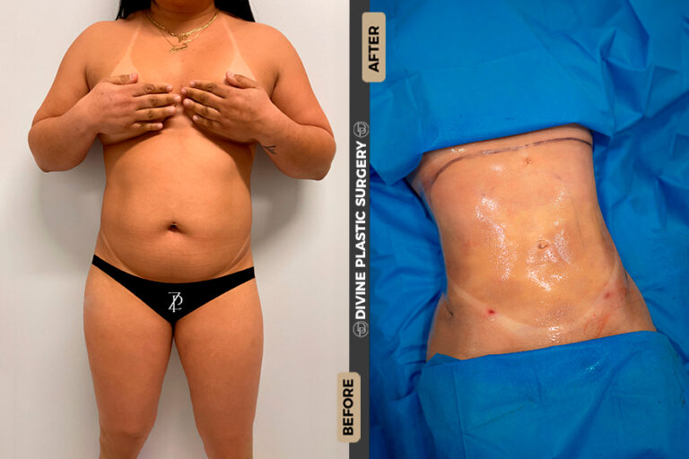 Liposuction procedure