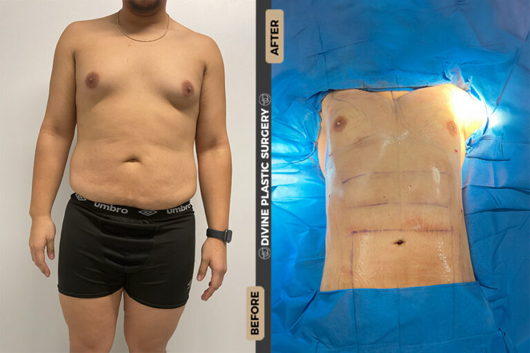 Liposuction procedure