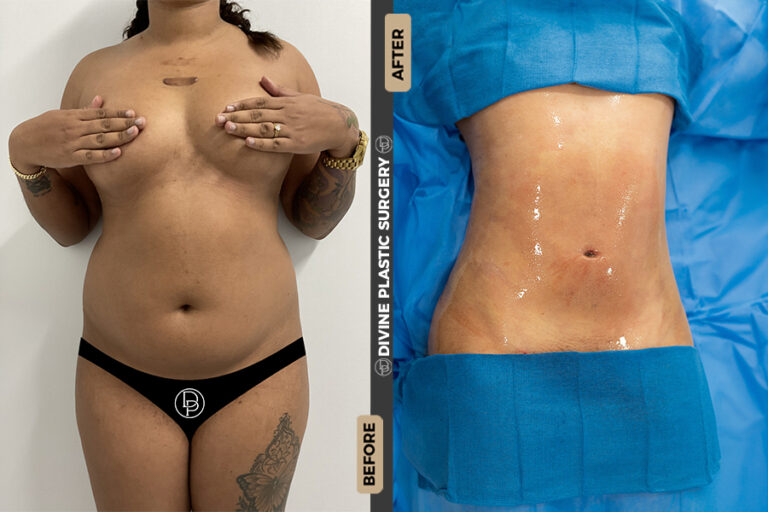 Lipo