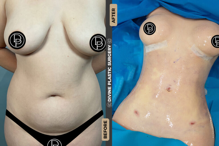 Liposuction 360