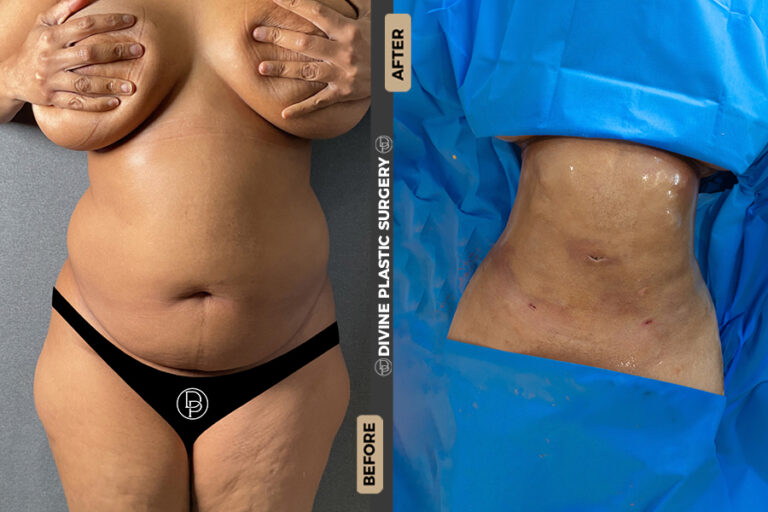 Liposuction procedure