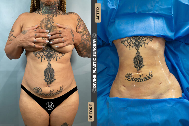 Liposuction procedure