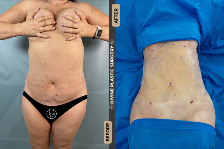 Lipo 360