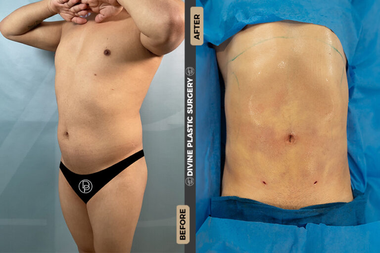 Liposuction surgery