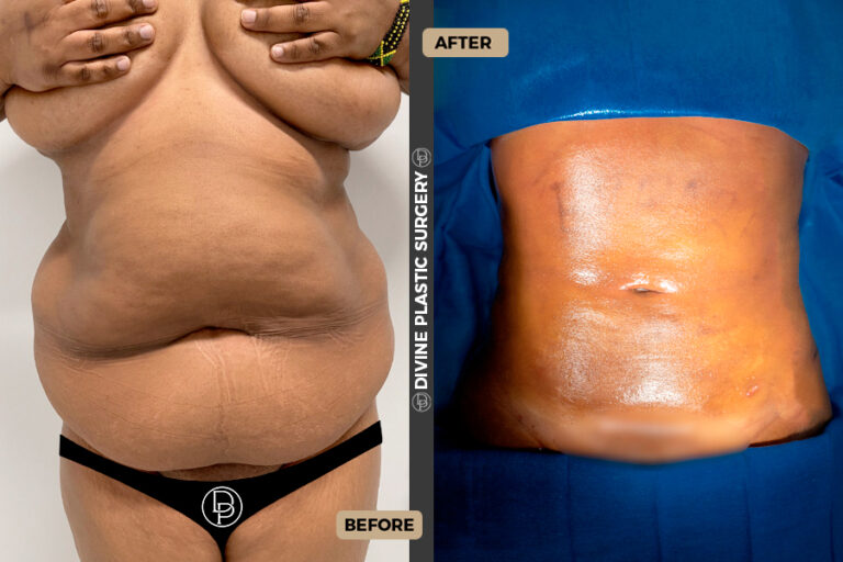 lipo in miami
