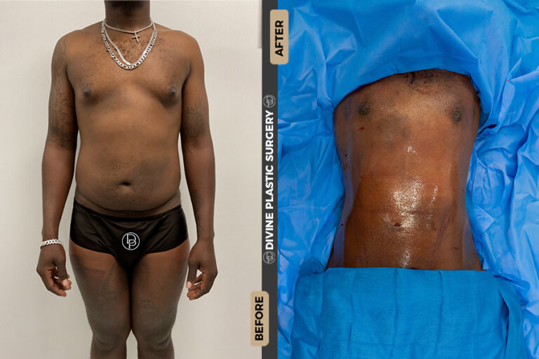 Liposuction