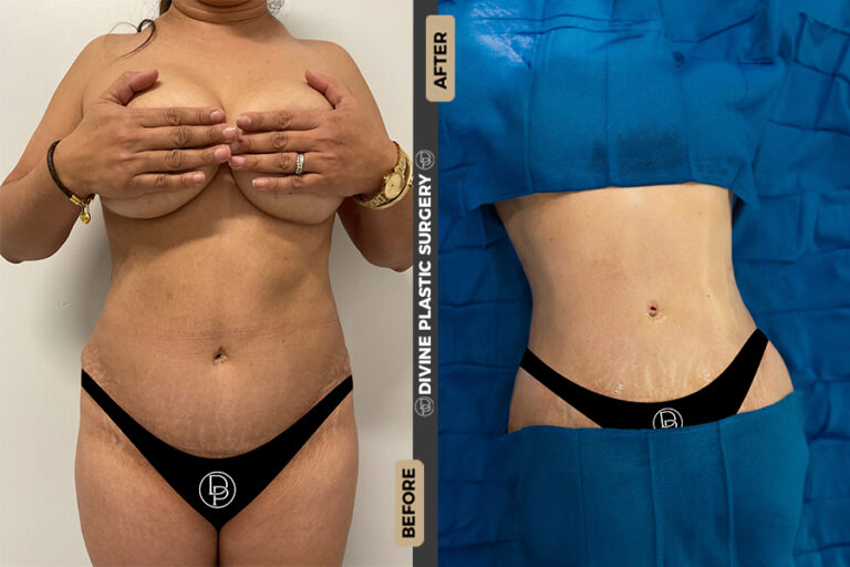 Lipo