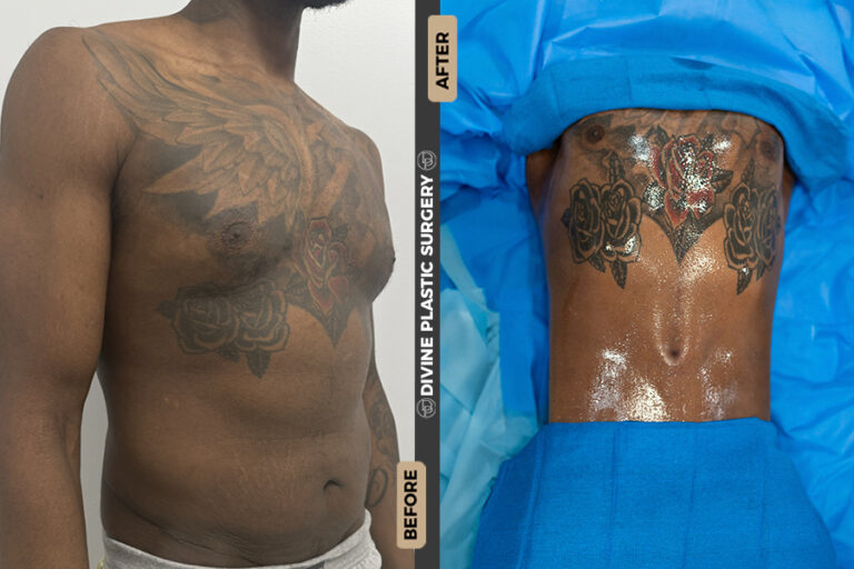 Liposuction