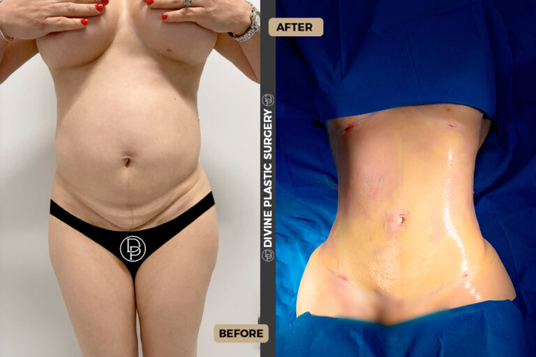 fat removal surgery in miami