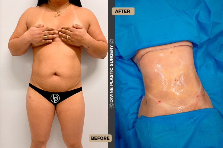 belly fat removal surgery