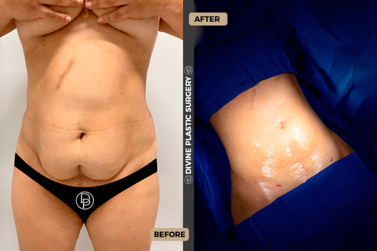 fat removal stomach