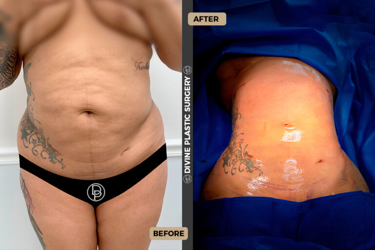 procedure to remove fat