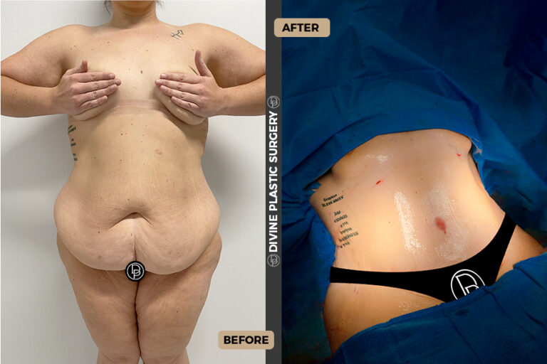 plus size tummy tuck in Divine