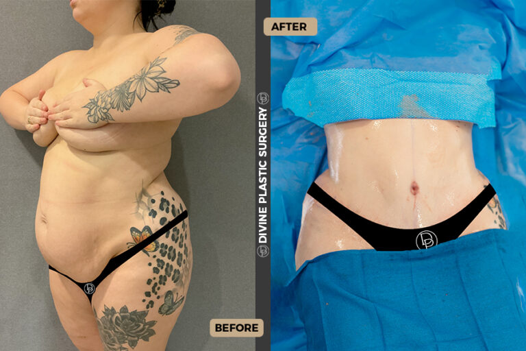 tummy tuck Divine surgery