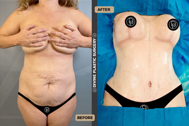 tummy tuck surgery Divine