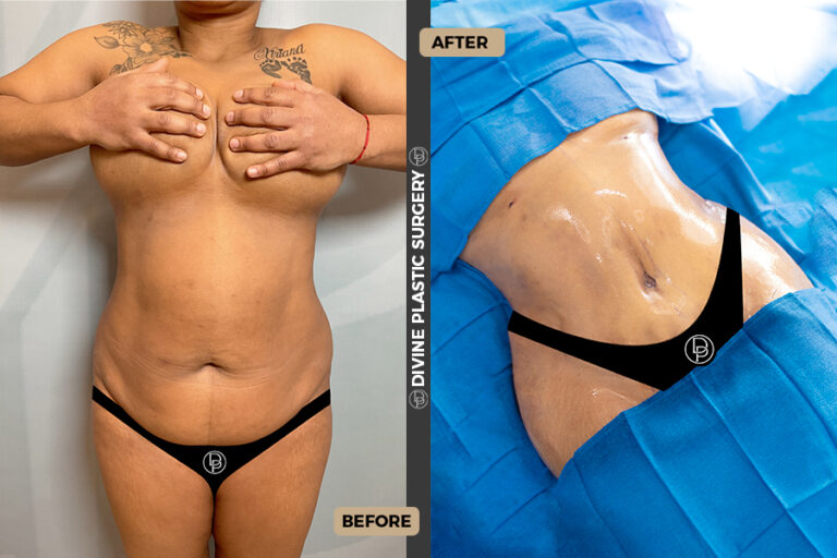cosmetic tummy tuck surgery