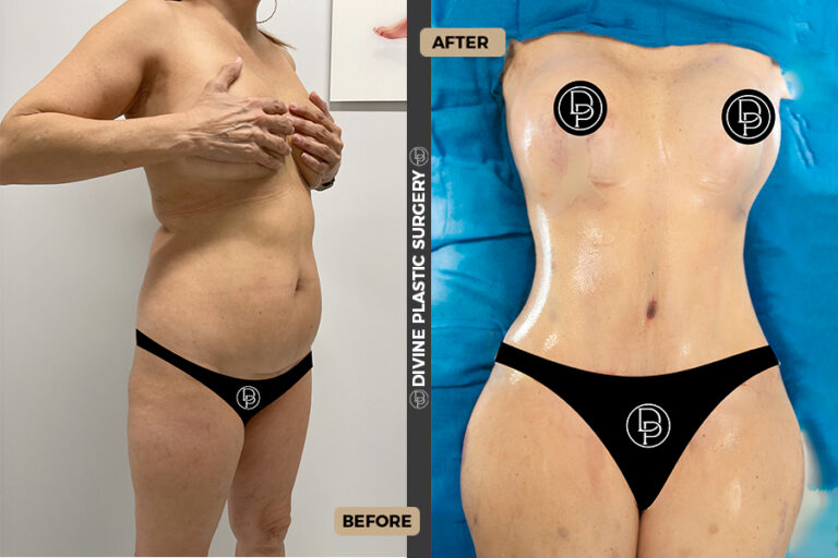 tummy tuck 360 surgery