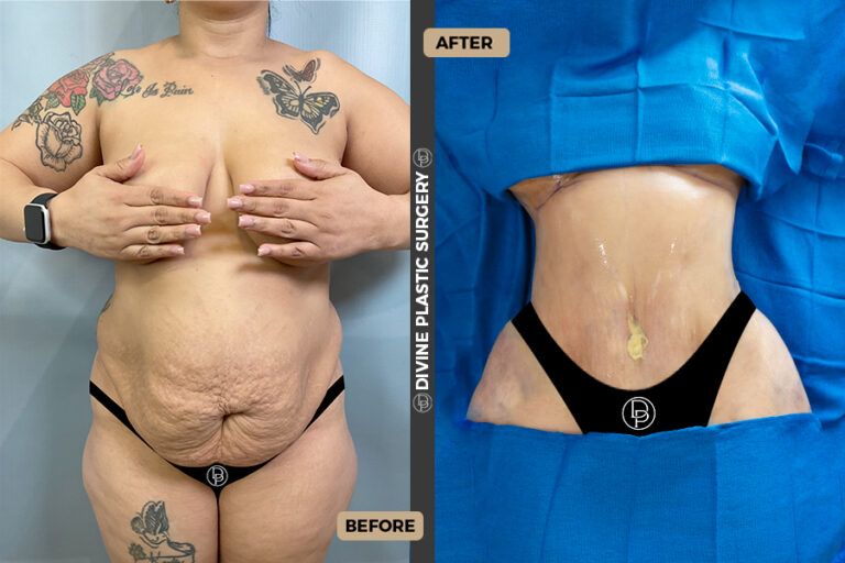 plus size tummy tuck in Divine