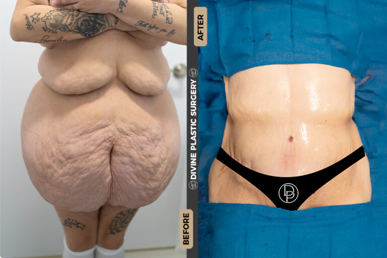 plus size tummy tuck in Divine