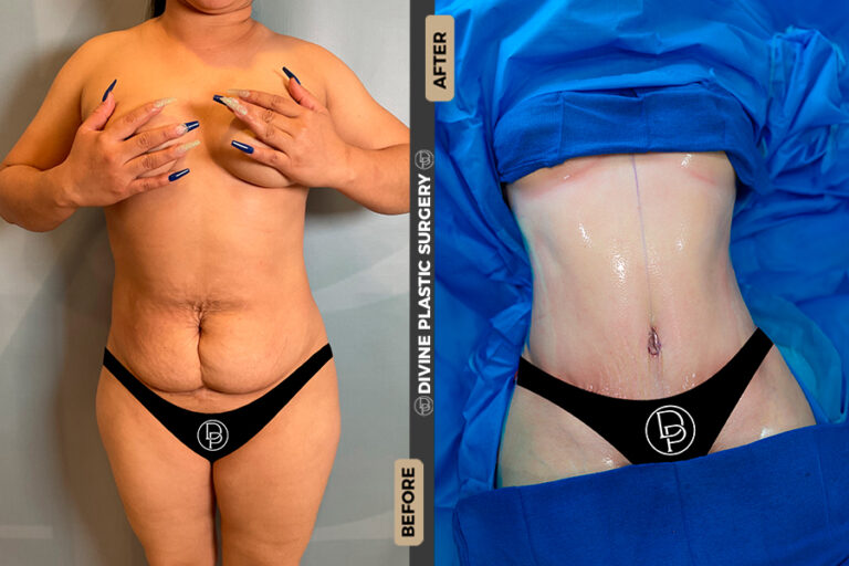 tummy tuck surgery