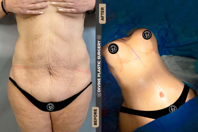 plus size tummy tuck