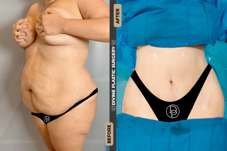 tummy tuck surgery