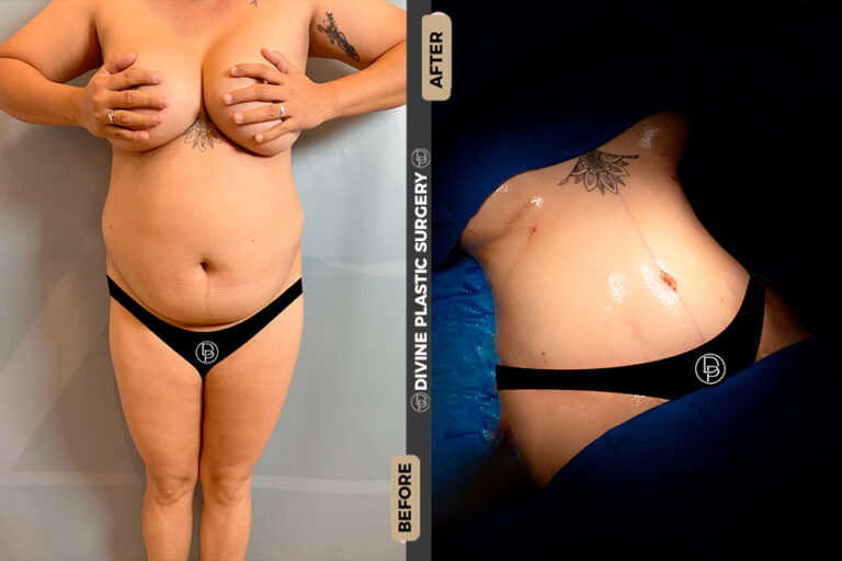 tummy tuck surgery in Miami