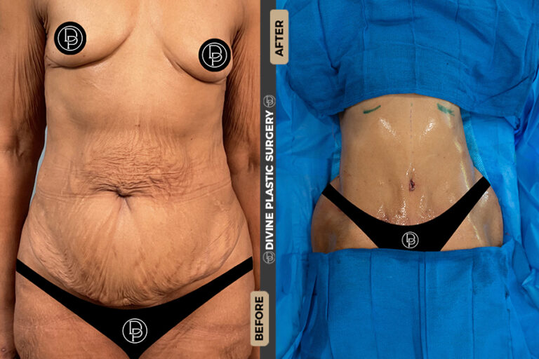 removing excess fat